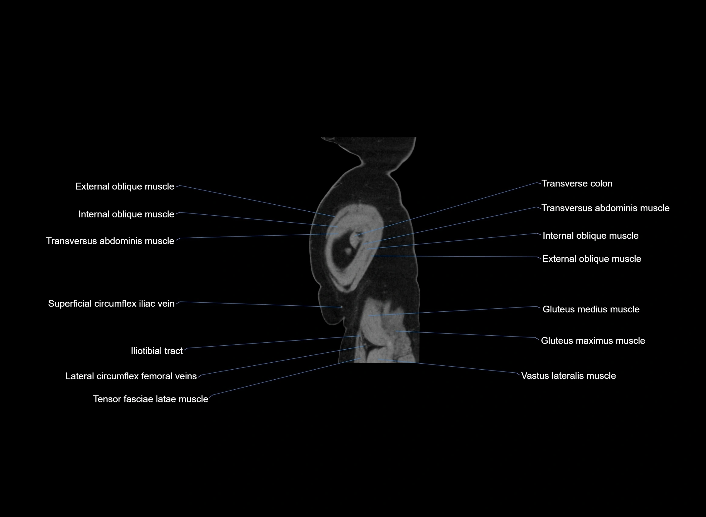 CT Abdomen sagittal cross sectional anatomy labelled radiology image -00008.webp